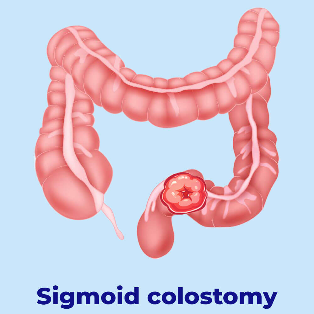 Colostomy Diet What Can I Eat Without Consequences