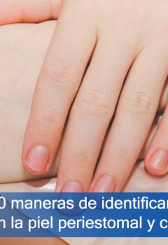 10 maneras de identificar irritación en la piel periestomal y cómo manejarla