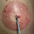 Redness-due-to-allergy-to-products-Allergic-Dermatitis_en