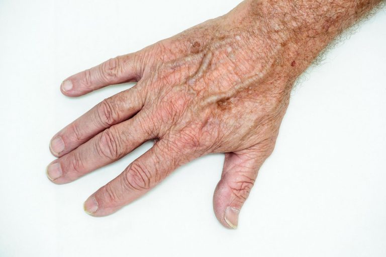 Mano di un anziano con macchie dovute all'invecchiamento