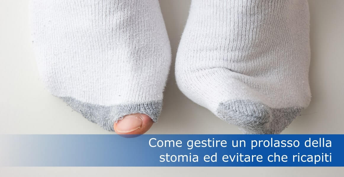 come gestire un prolasso della stomia title image